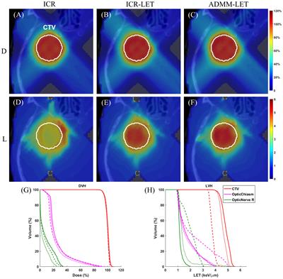 Optimizing linear energy transfer distribution in intensity-modulated proton therapy using the alternating direction method of multipliers